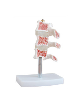 CUTAWAY OSTEOPOROSIS